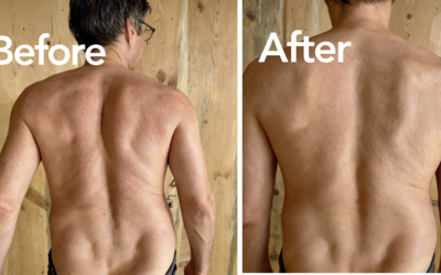 How One Fasciapuncture® Session Restored Alignment After Sudden Back Collapse — A Real Story