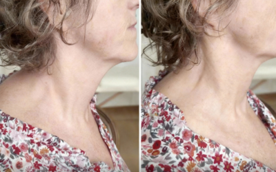 A Gentle Release of the Neck–Shoulder Fascia: A Subtle but Meaningful Transformation