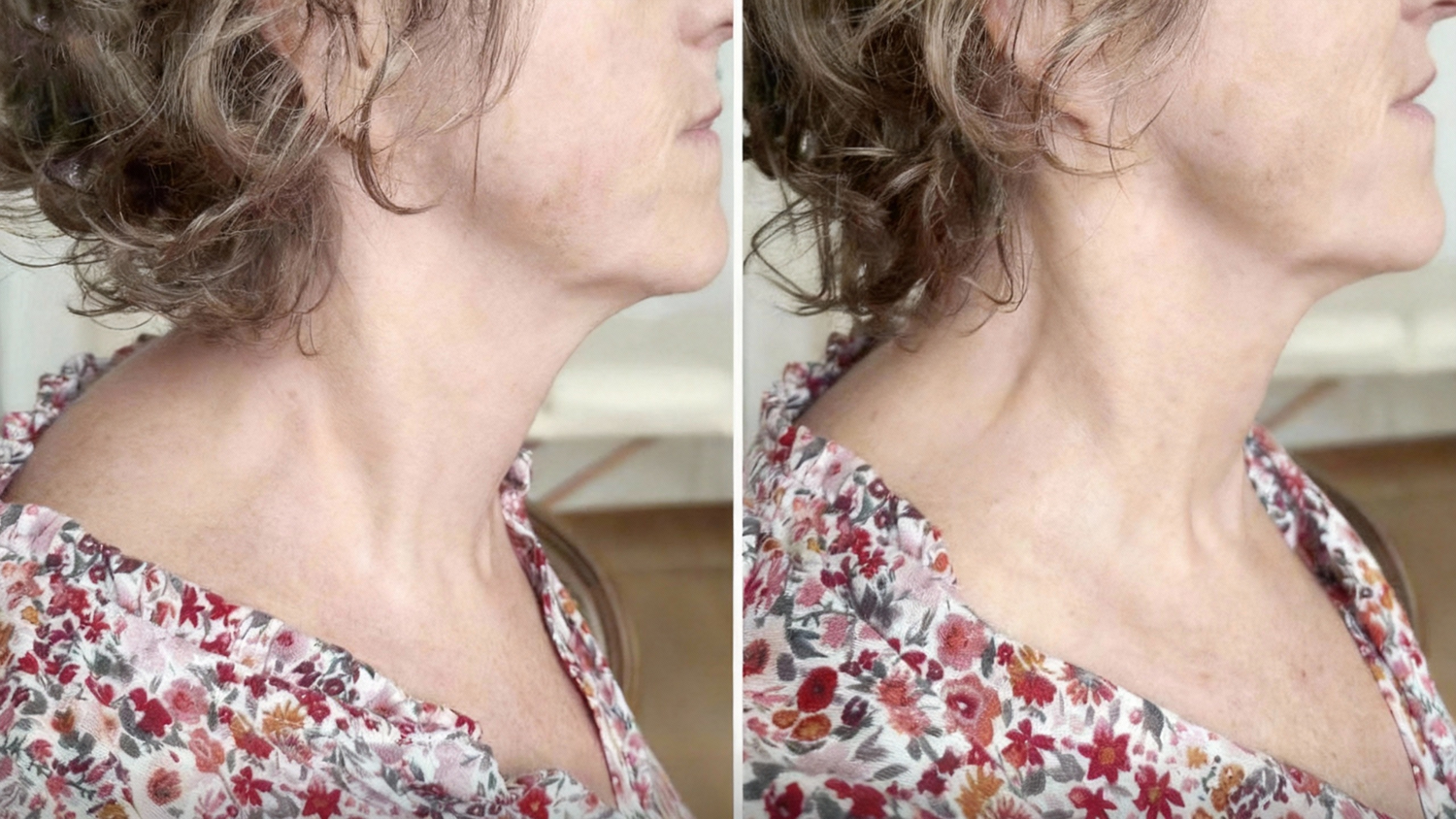 Neck tension and upper exit block clinical case