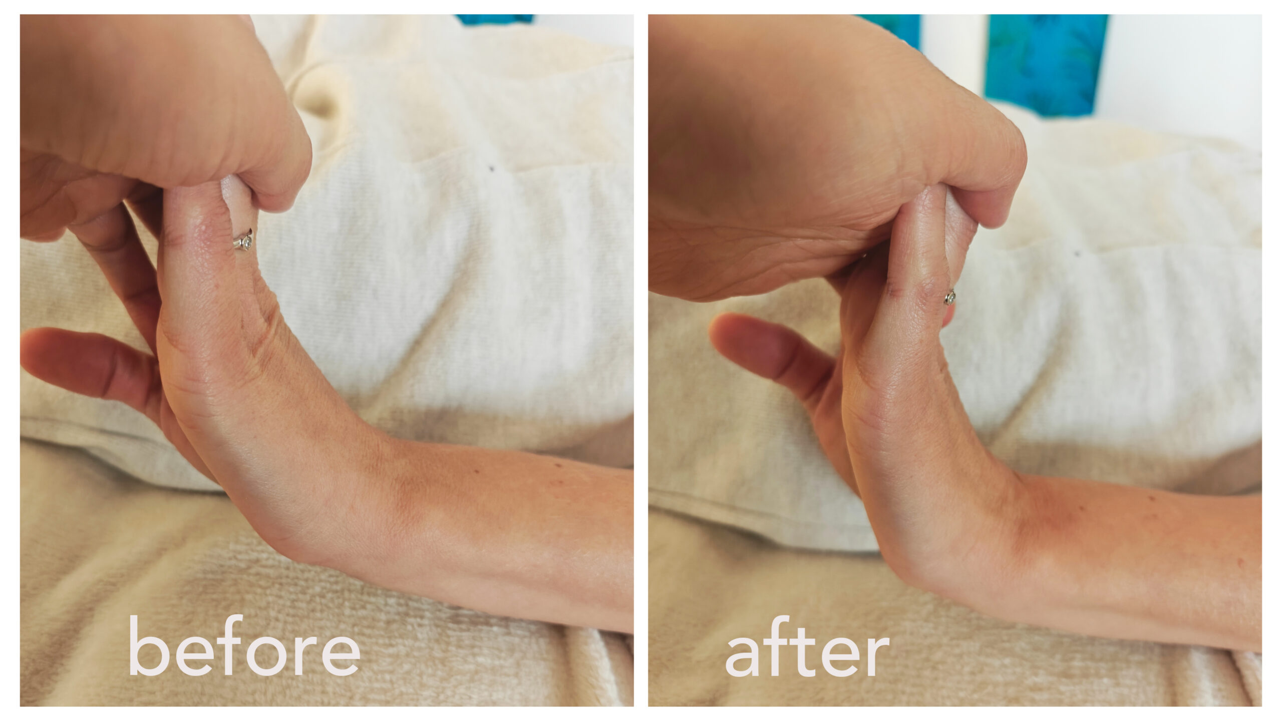 Wrist mobility before and after fascial release clinical case