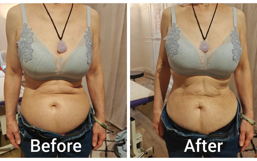 When the Abdomen Changes Without Weight Loss