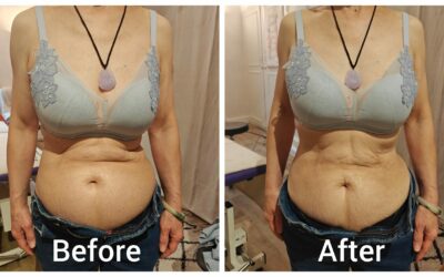 When the Abdomen Changes Without Weight Loss