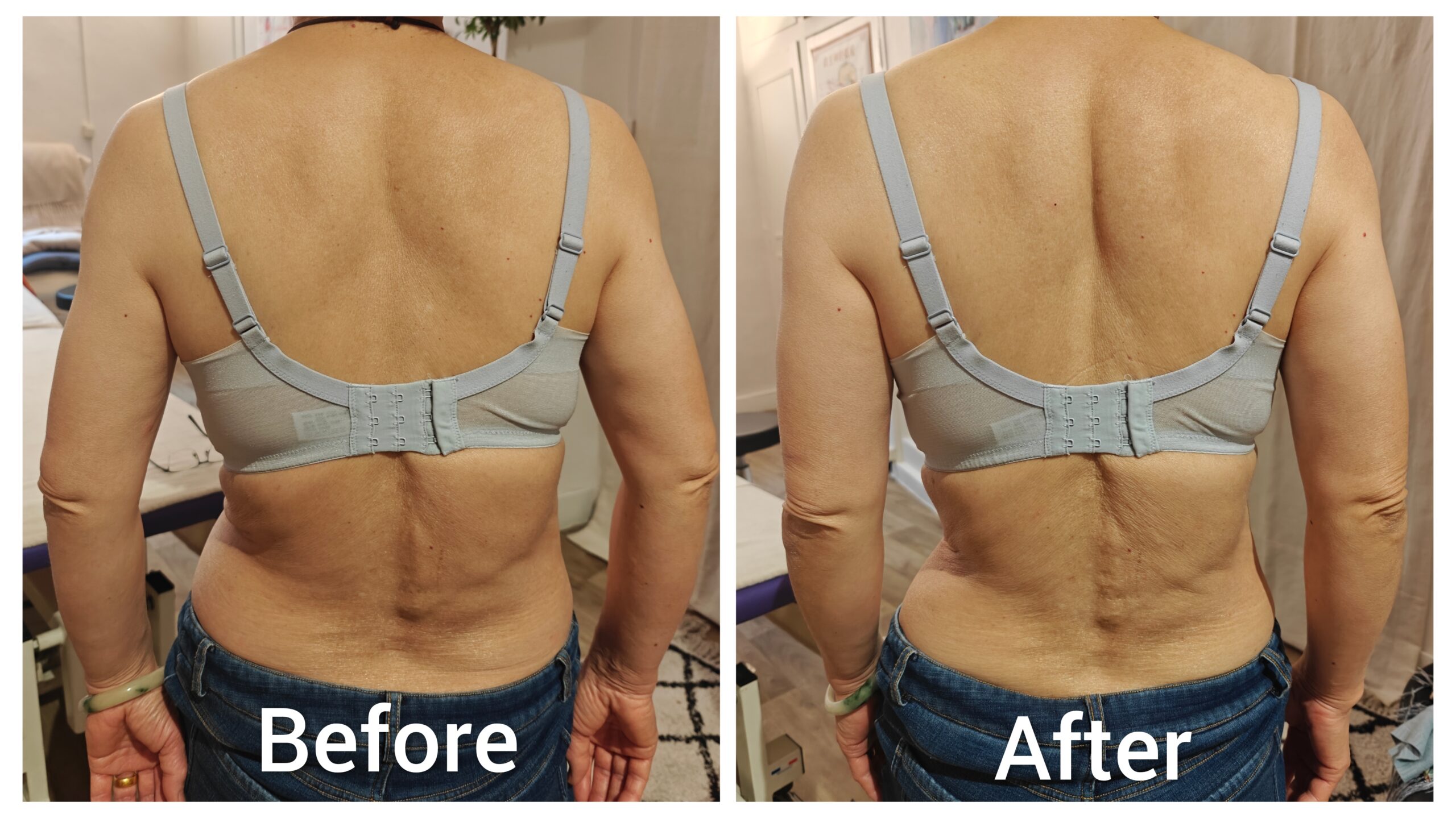 Before and after posterior spinal asymmetry and postural collapse improvement after Fasciapuncture
