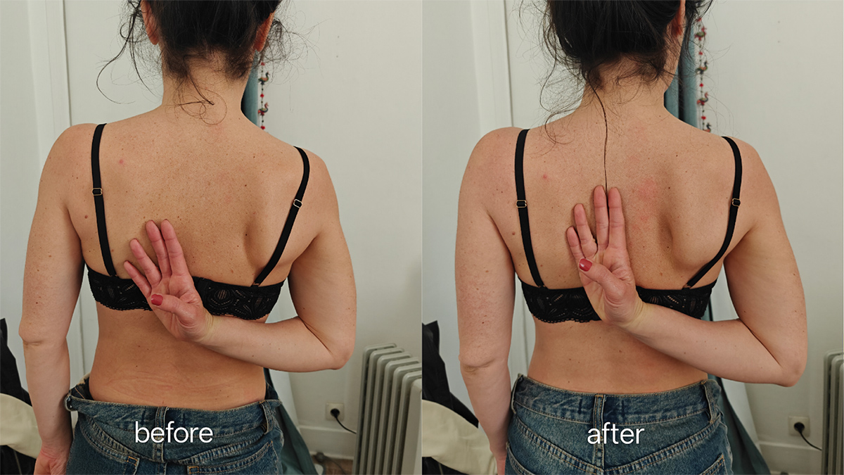 Before and after hand behind back movement in nocturnal hand numbness case