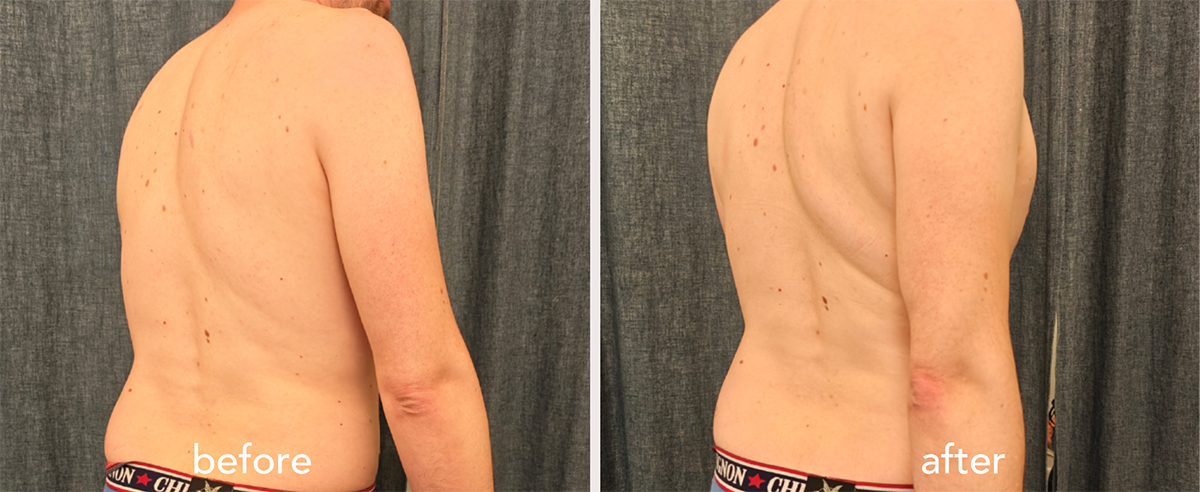 Before and after posture change in chronic sciatic pain case