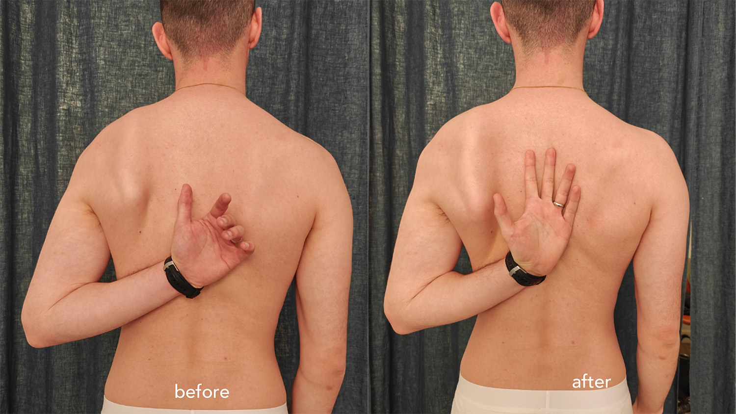 Before and after shoulder mobility clinical case