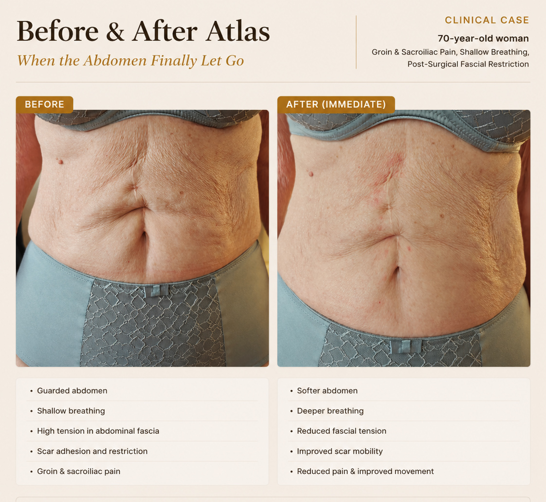 Abdominal scar and fascial restriction
