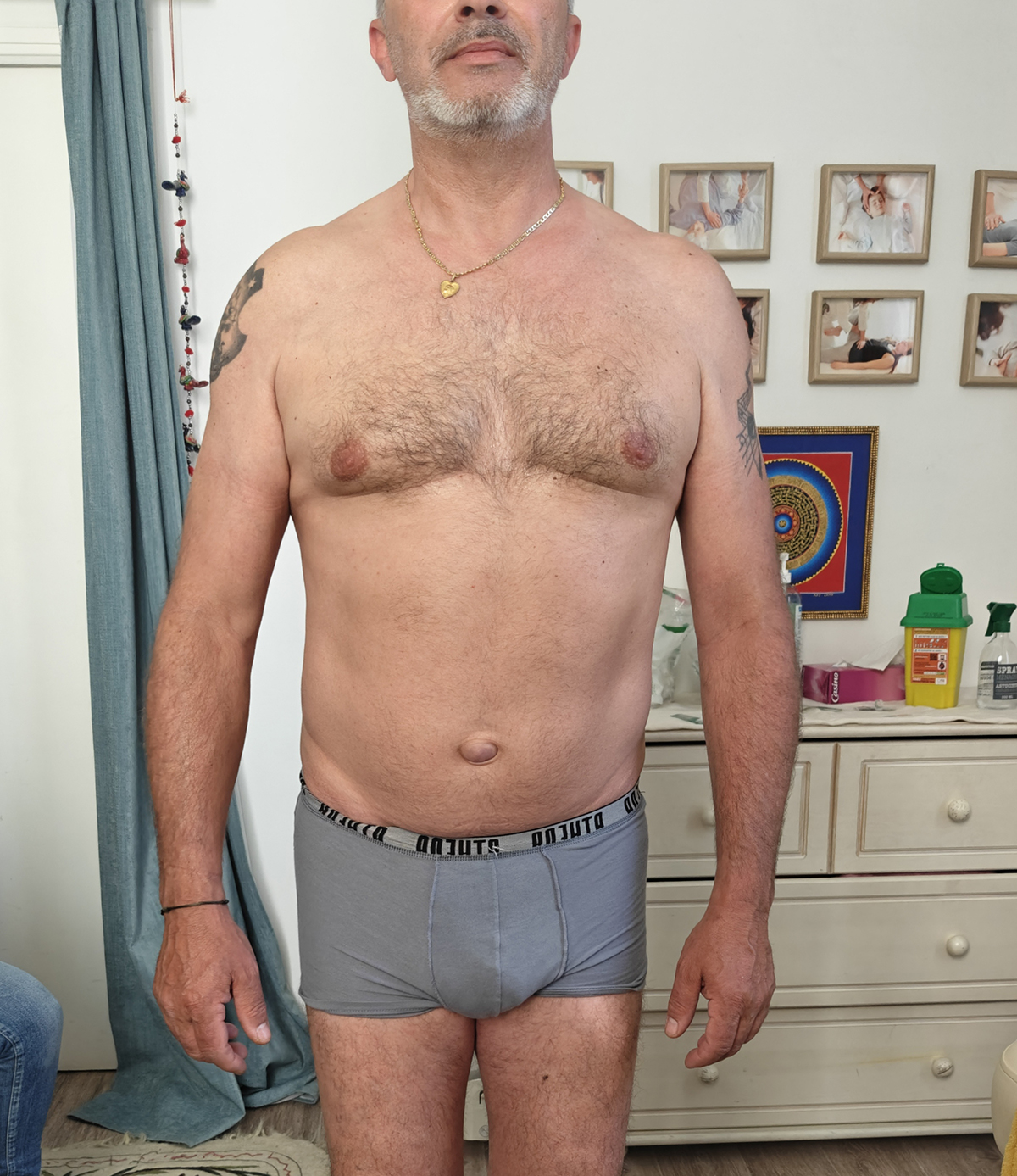 Front view before treatment showing abdominal and shoulder compensation