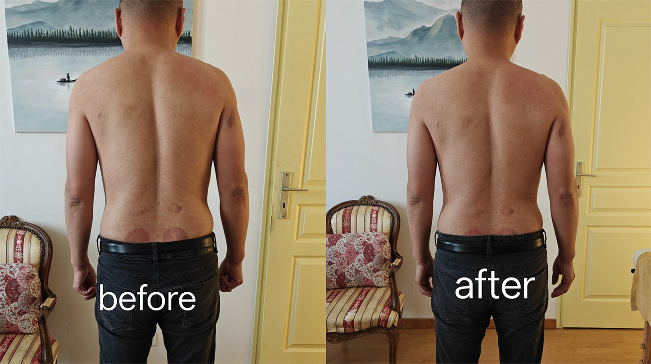 Front view before and after acute low back locking