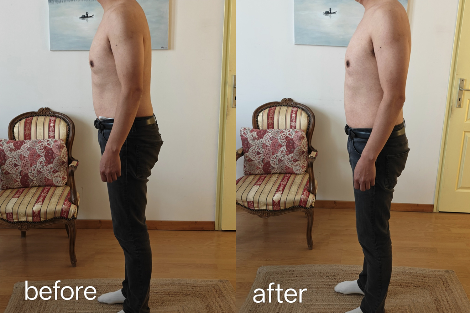 Lumbar locking and shoulder compensation clinical case