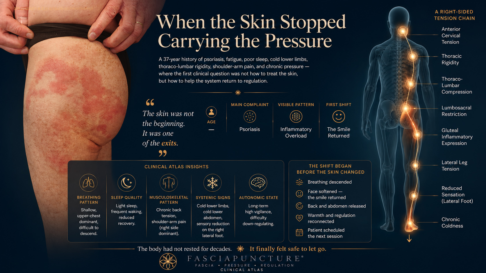 Chronic inflammatory overload and psoriasis clinical case in Fasciapuncture