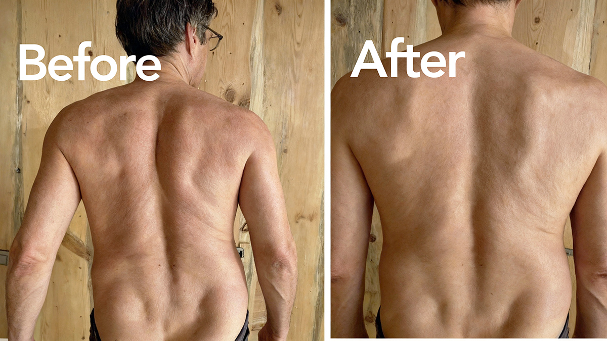 Before Fasciapuncture session showing trunk deviation and back collapse