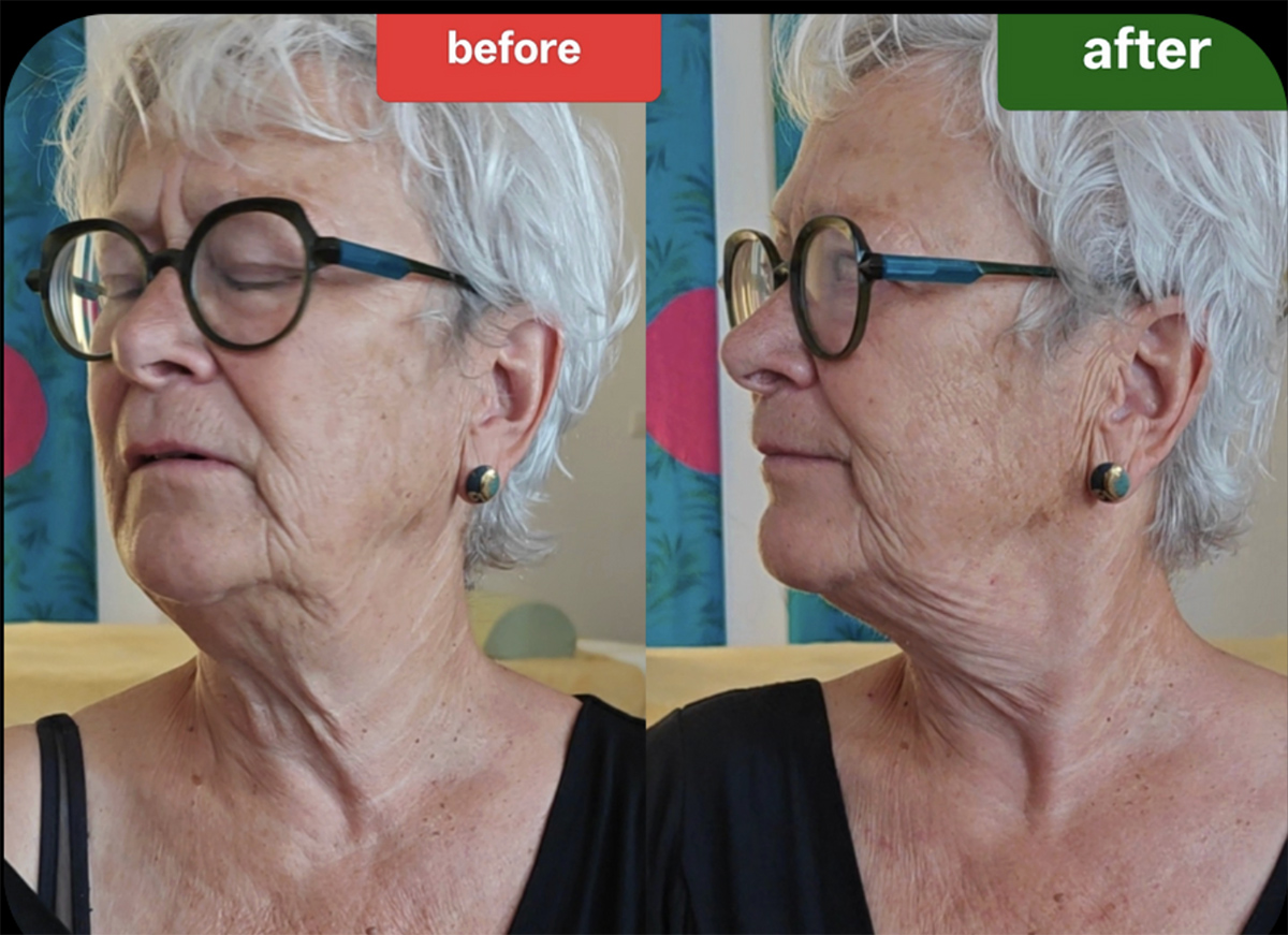 Before and after neck rotation