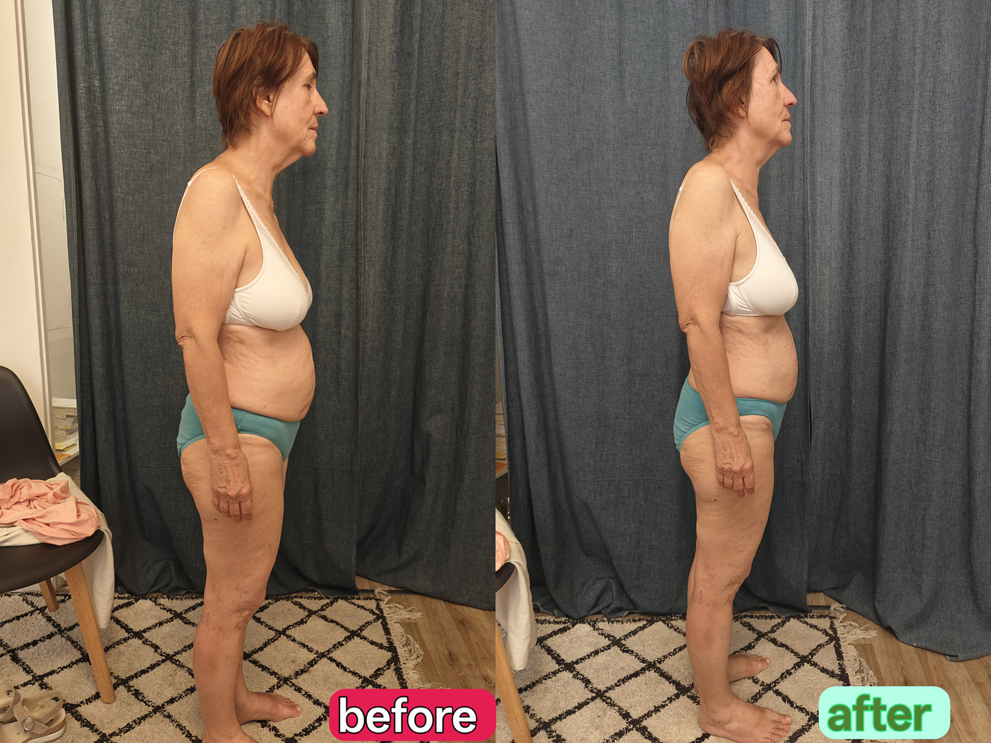 Clinical observation of walking balance and lower-body support